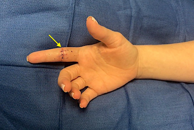 Flexor Tendon Laceration Hand Surgery Resource 4597